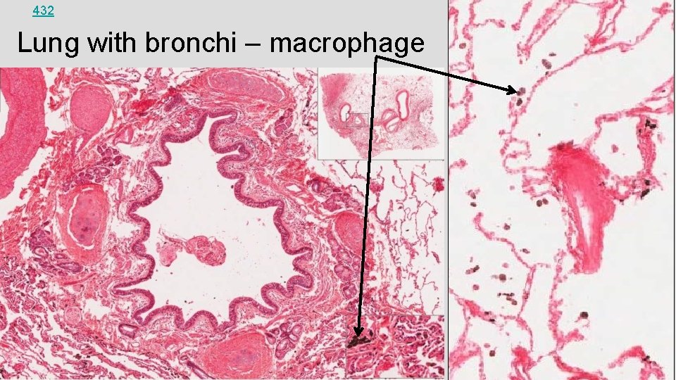 432 Lung with bronchi – macrophage 