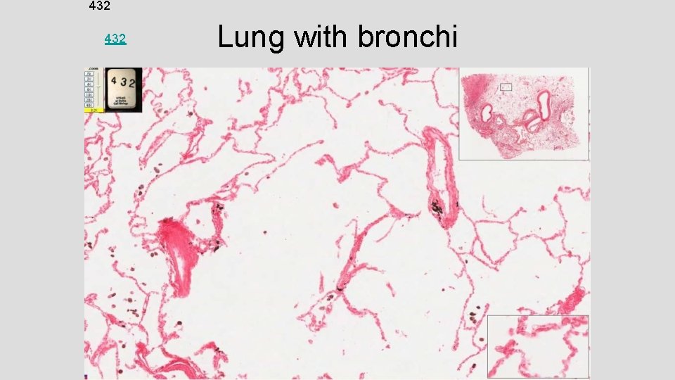 432 Lung with bronchi 
