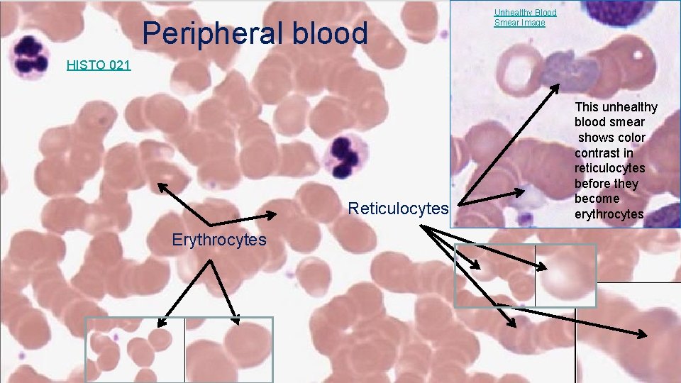 Peripheral blood Unhealthy Blood Smear Image HISTO 021 Reticulocytes Erythrocytes This unhealthy blood smear