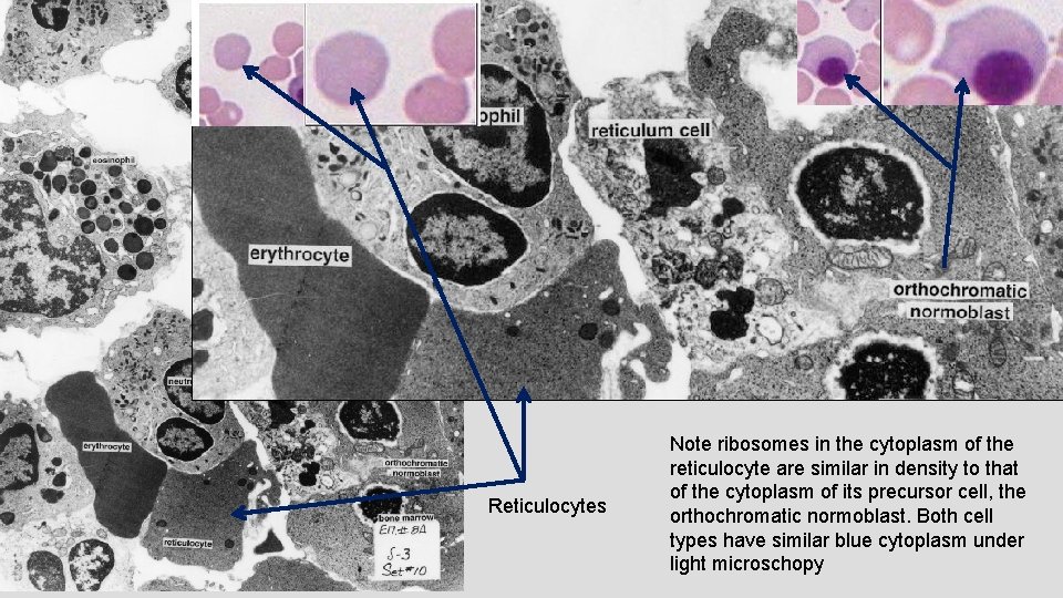 Reticulocytes Note ribosomes in the cytoplasm of the reticulocyte are similar in density to