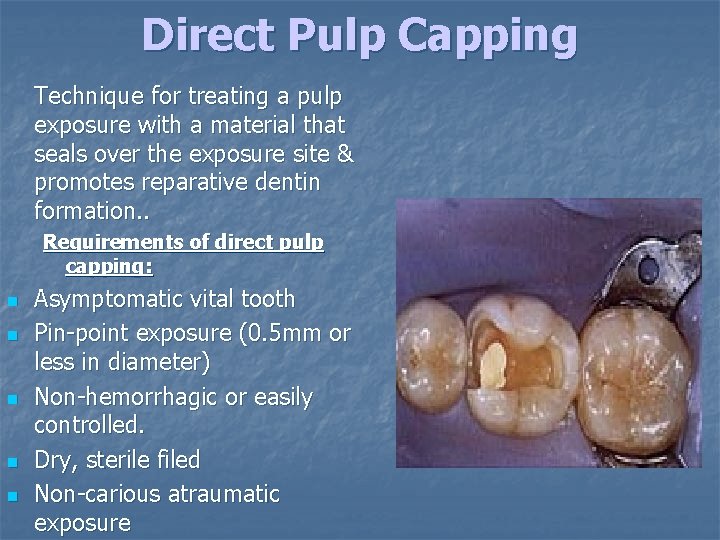 Direct Pulp Capping Technique for treating a pulp exposure with a material that seals