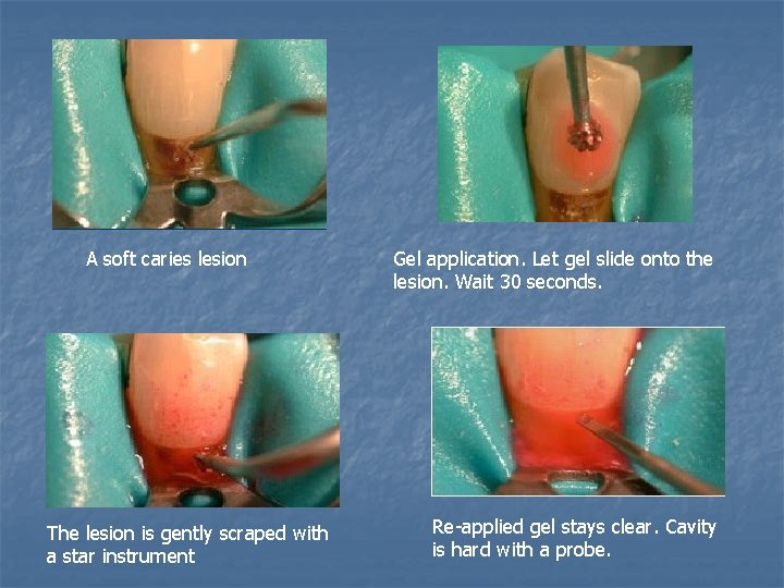 A soft caries lesion The lesion is gently scraped with a star instrument Gel