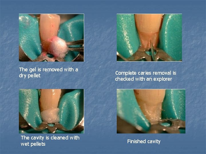 The gel is removed with a dry pellet The cavity is cleaned with wet