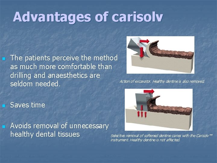 Advantages of carisolv n n n The patients perceive the method as much more