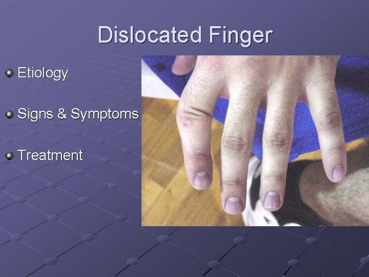 Dislocated Finger Etiology Signs & Symptoms Treatment 