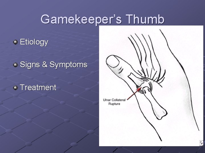 Gamekeeper’s Thumb Etiology Signs & Symptoms Treatment 