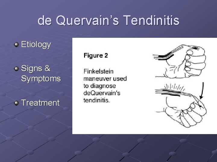 de Quervain’s Tendinitis Etiology Signs & Symptoms Treatment 