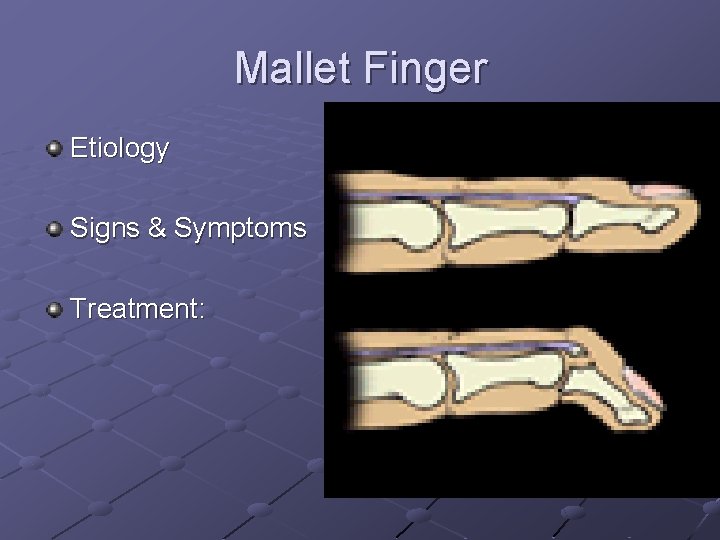 Mallet Finger Etiology Signs & Symptoms Treatment: 