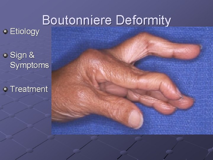 Etiology Boutonniere Deformity Sign & Symptoms Treatment 