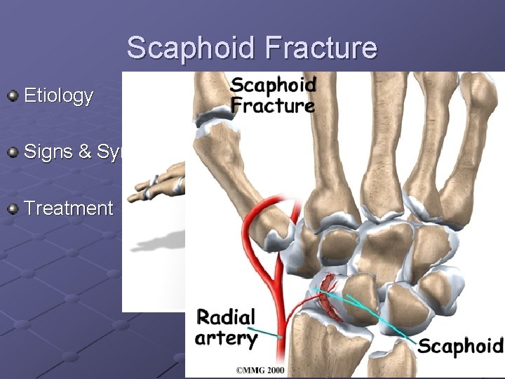 Scaphoid Fracture Etiology Signs & Symptoms Treatment 