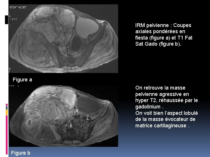 IRM pelvienne : Coupes axiales pondérées en fiesta (figure a) et T 1 Fat