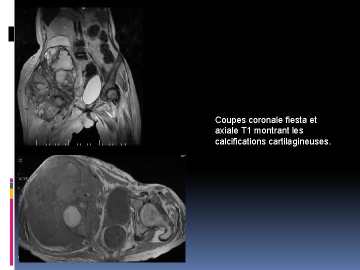 Coupes coronale fiesta et axiale T 1 montrant les calcifications cartilagineuses. 