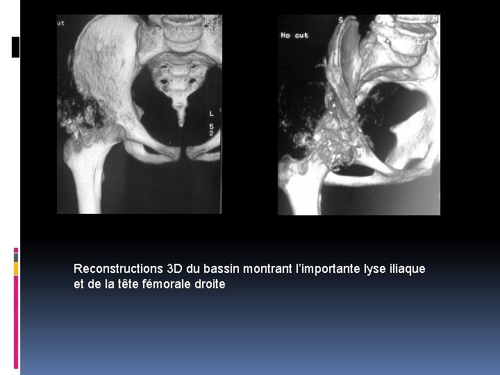 Reconstructions 3 D du bassin montrant l’importante lyse iliaque et de la tête fémorale