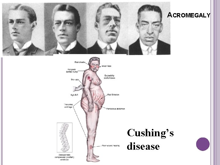 ACROMEGALY Cushing’s disease 