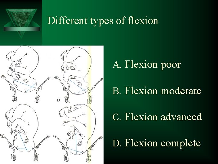 Different types of flexion A. Flexion poor B. Flexion moderate C. Flexion advanced D.