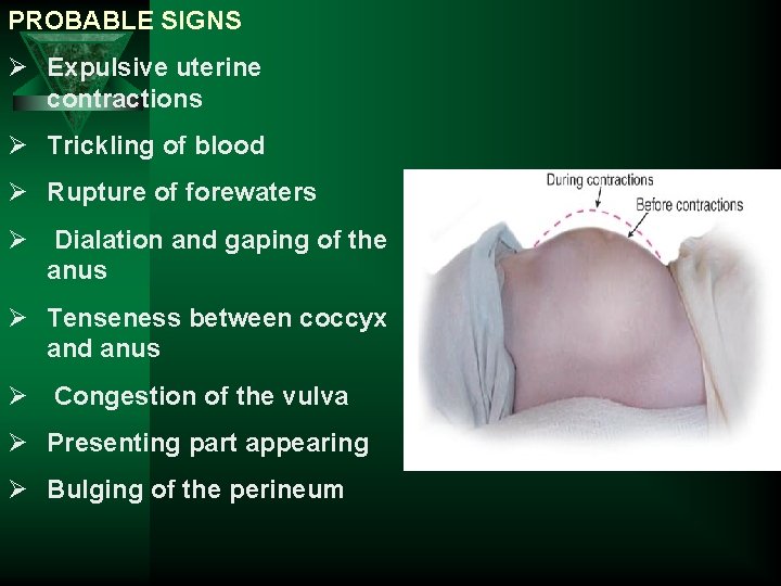 PROBABLE SIGNS Ø Expulsive uterine contractions Ø Trickling of blood Ø Rupture of forewaters