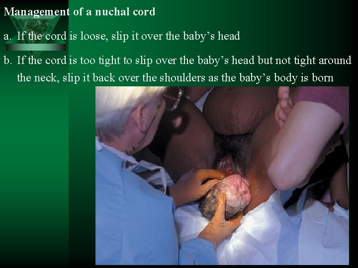 Management of a nuchal cord a. If the cord is loose, slip it over