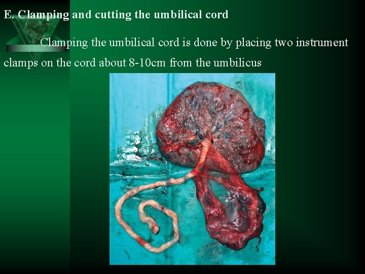 E. Clamping and cutting the umbilical cord Clamping the umbilical cord is done by