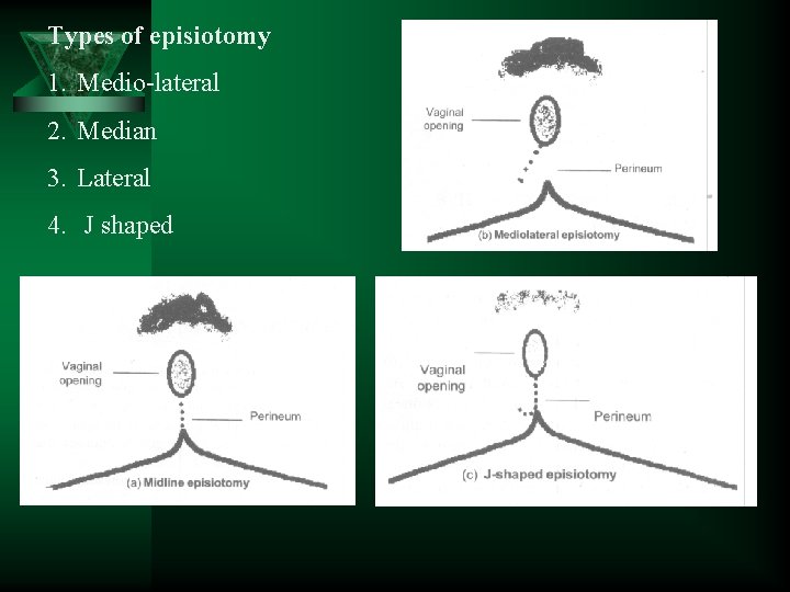 Types of episiotomy 1. Medio-lateral 2. Median 3. Lateral 4. J shaped 