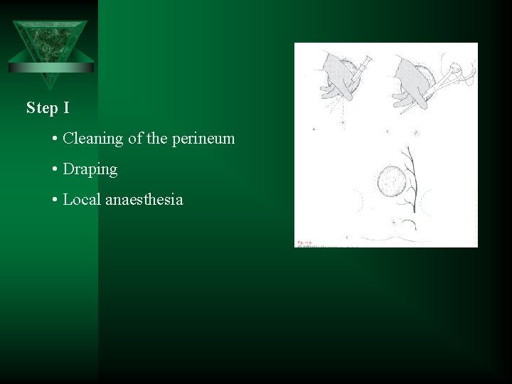 Step I • Cleaning of the perineum • Draping • Local anaesthesia 