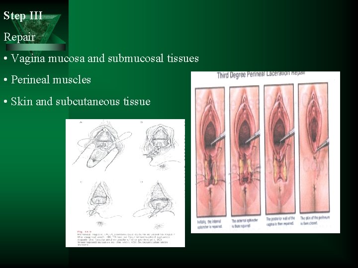 Step III Repair • Vagina mucosa and submucosal tissues • Perineal muscles • Skin