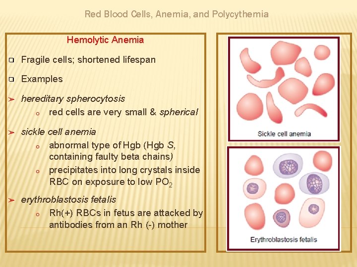 Red Blood Cells, Anemia, and Polycythemia Hemolytic Anemia ❑ Fragile cells; shortened lifespan ❑