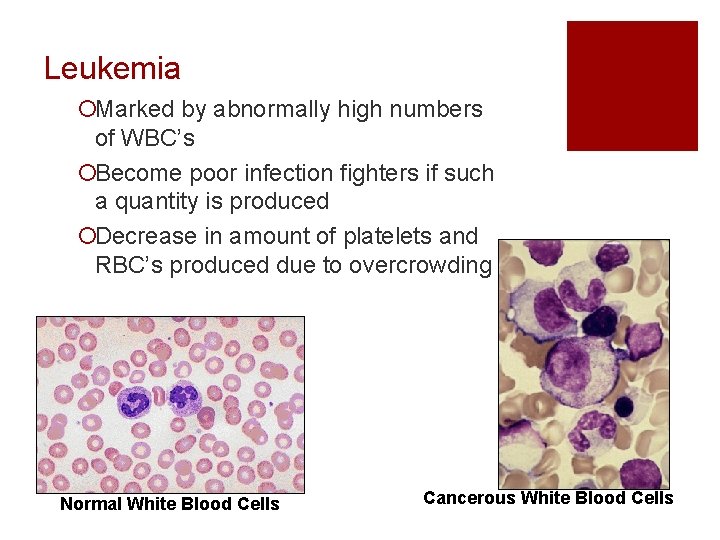 Leukemia ¡Marked by abnormally high numbers of WBC’s ¡Become poor infection fighters if such