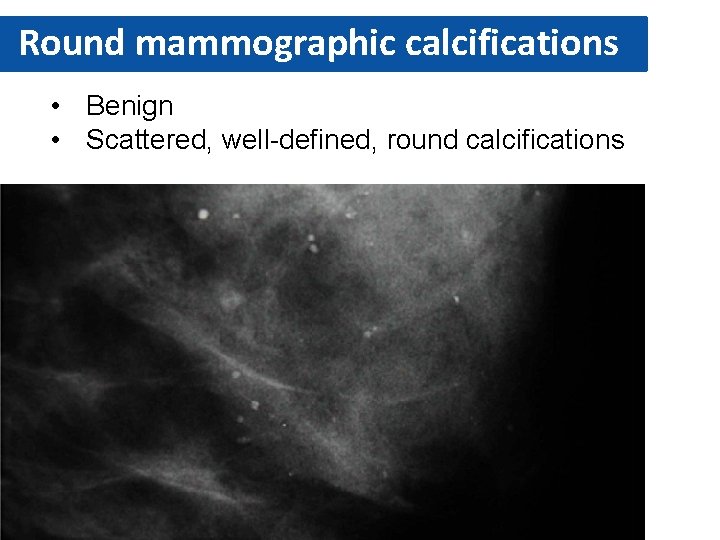 Round mammographic calcifications • Benign • Scattered, well-defined, round calcifications 