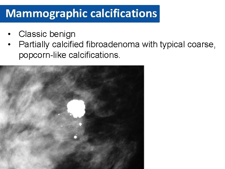 Mammographic calcifications • Classic benign • Partially calcified fibroadenoma with typical coarse, popcorn-like calcifications.