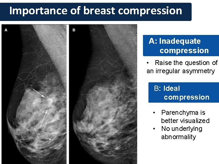 Importance of breast compression A: Inadequate compression • Raise the question of an irregular
