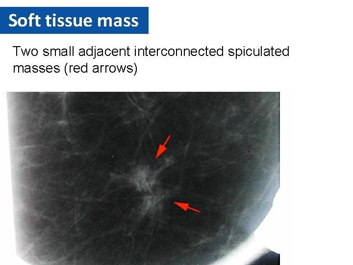 Soft tissue mass Two small adjacent interconnected spiculated masses (red arrows) 