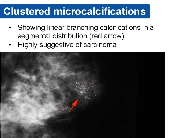 Clustered microcalcifications • Showing linear branching calcifications in a segmental distribution (red arrow) •
