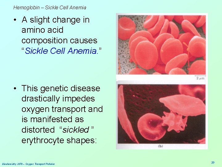 Hemoglobin – Sickle Cell Anemia • A slight change in amino acid composition causes