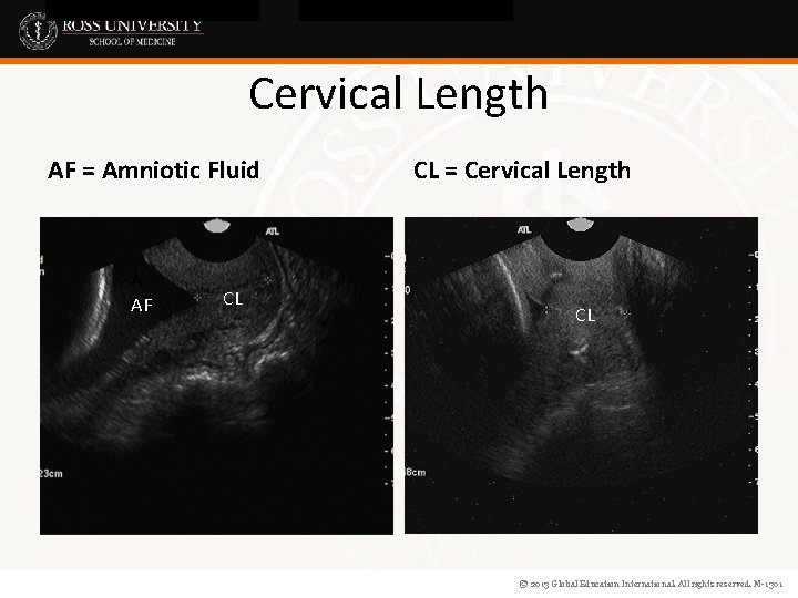 Cervical Length AF = Amniotic Fluid A AF CL CL = Cervical Length CL