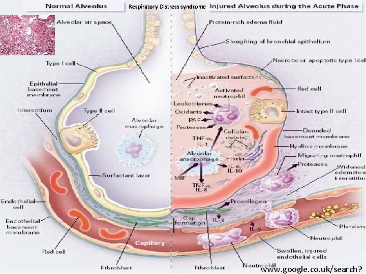 Respiratory Distress syndrome www. google. co. uk/search? 