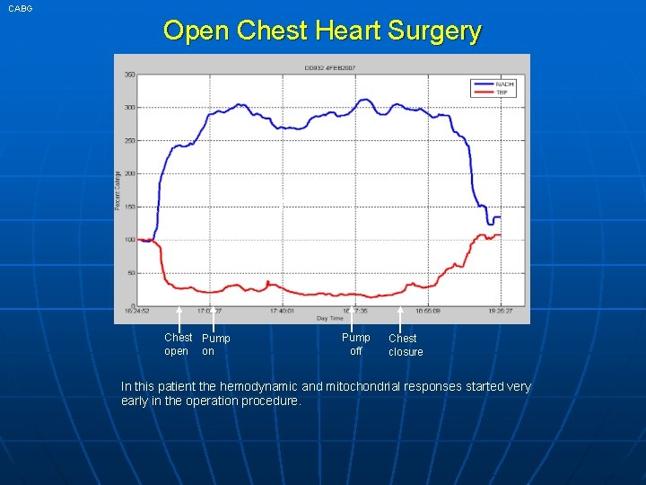 CABG Open Chest Heart Surgery 38 min Chest Pump open on Pump off Chest