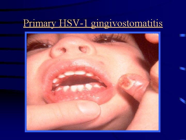 Primary HSV-1 gingivostomatitis 