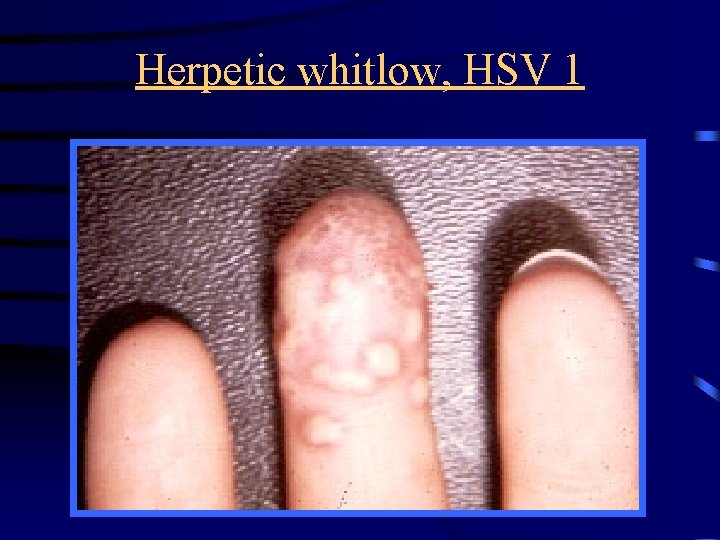 Herpetic whitlow, HSV 1 