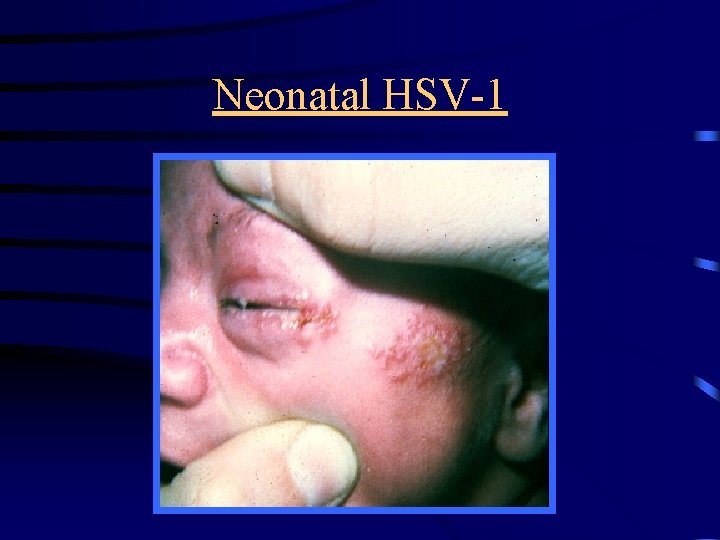 Neonatal HSV-1 