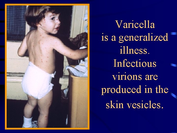 Varicella is a generalized illness. Infectious virions are produced in the skin vesicles. 