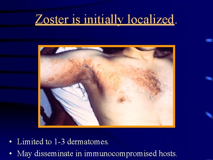 Zoster is initially localized. • Limited to 1 -3 dermatomes. • May disseminate in