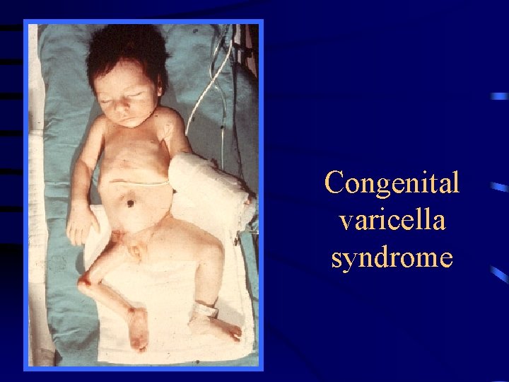 Congenital varicella syndrome 