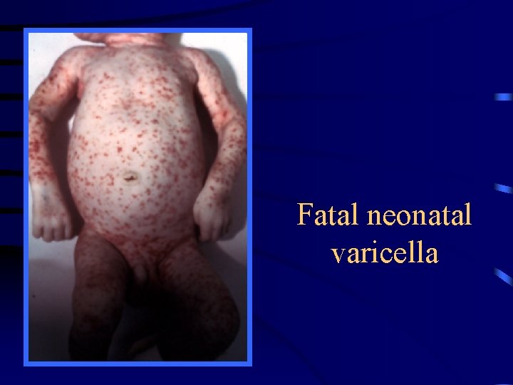 Fatal neonatal varicella 