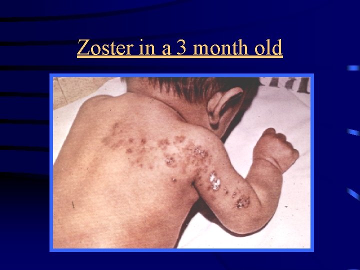 Zoster in a 3 month old 