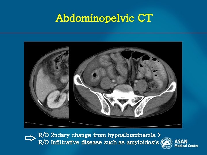 Abdominopelvic CT R/O 2 ndary change from hypoalbuminemia > R/O Infiltrative disease such as