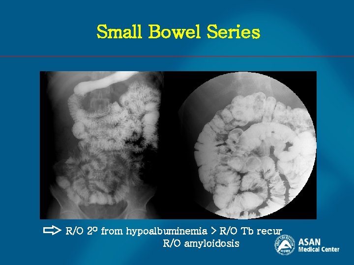 Small Bowel Series R/O 2 O from hypoalbuminemia > R/O Tb recur R/O amyloidosis