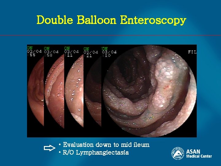 Double Balloon Enteroscopy • Evaluation down to mid ileum • R/O Lymphangiectasia 