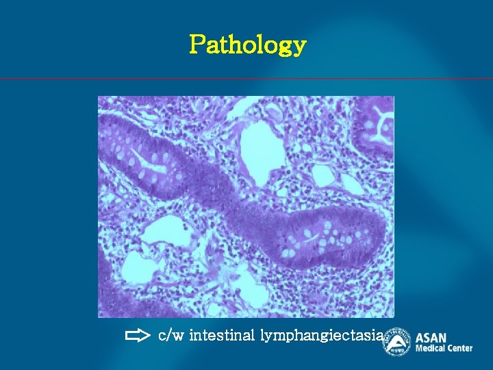 Pathology c/w intestinal lymphangiectasia 