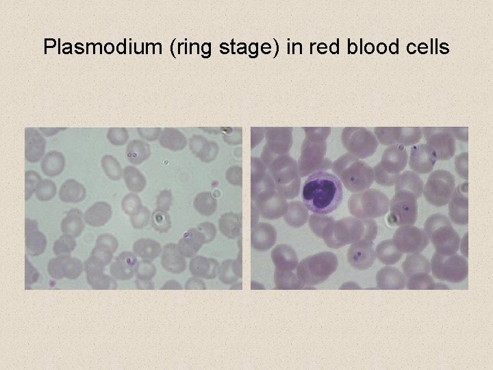 Plasmodium (ring stage) in red blood cells Plasmodium (ring stage) in red blood cells