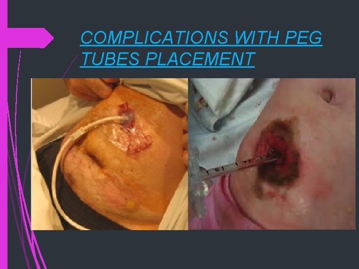 COMPLICATIONS WITH PEG TUBES PLACEMENT 